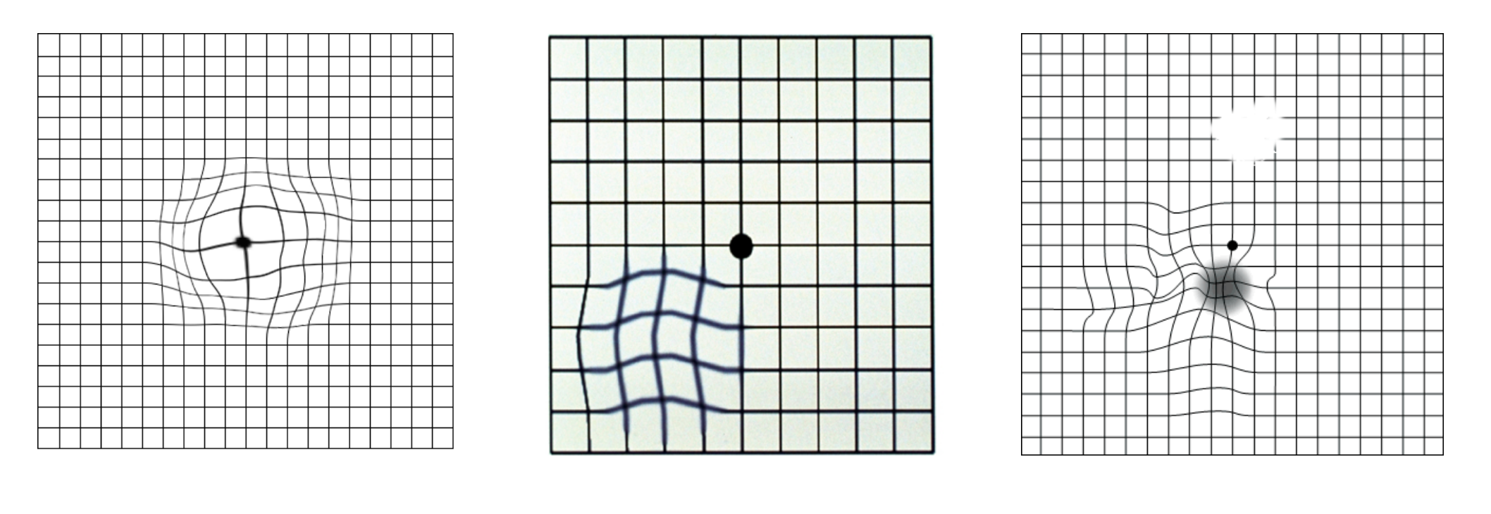 Amsler grid test pattern